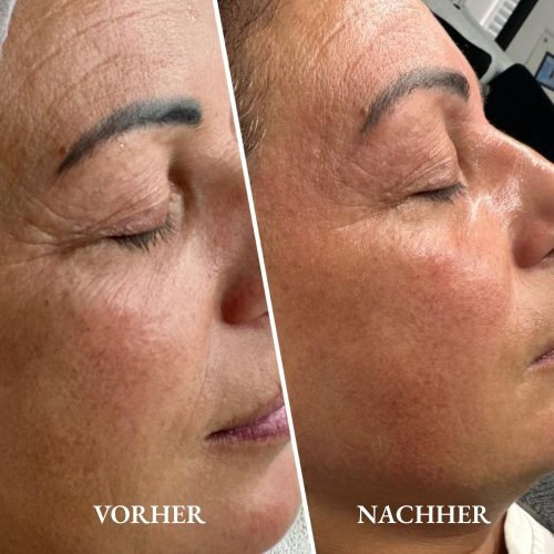 Anti-Age-Advanced Vorher-nachher: sichtbar glattere Haut nach Gesichtsbehandlung im Golden Studio Kosmetiksalon Fellbach.