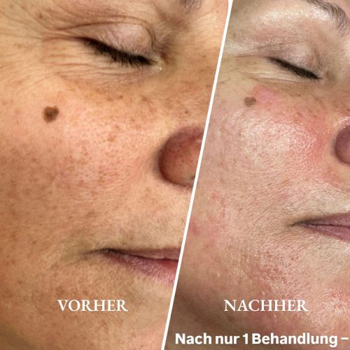 Vorher-Nachher Ergebnis einer Fruchtsäure-Gesichtsbehandlung mit verfeinertem Hautbild im Kosmetikstudio in Fellbach.