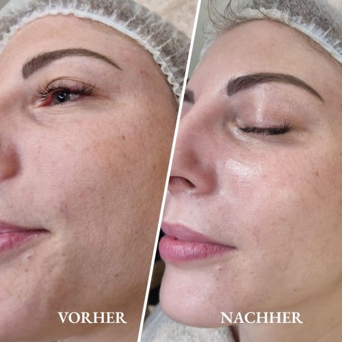Vorher-Nachher Ergebnis einer Hydro Care Gesichtsbehandlung für mehr Feuchtigkeit und Glow im Kosmetikstudio in Fellbach